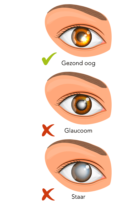 verschil gezond oog met glaucoom en staar