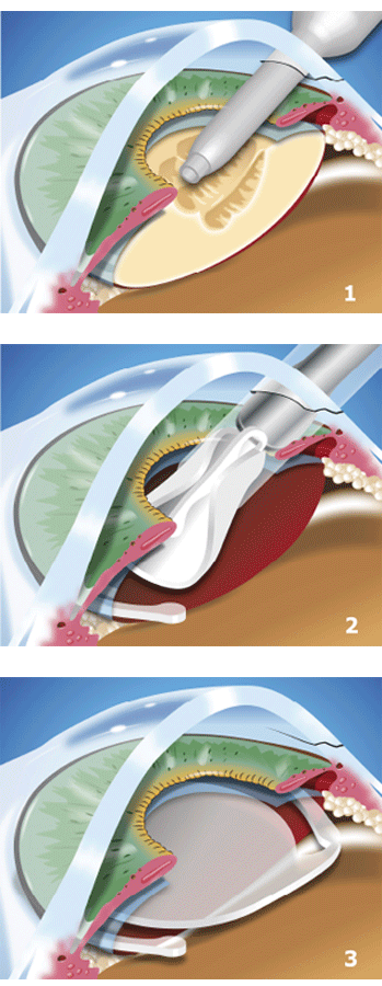 implantlenzen plaatsen